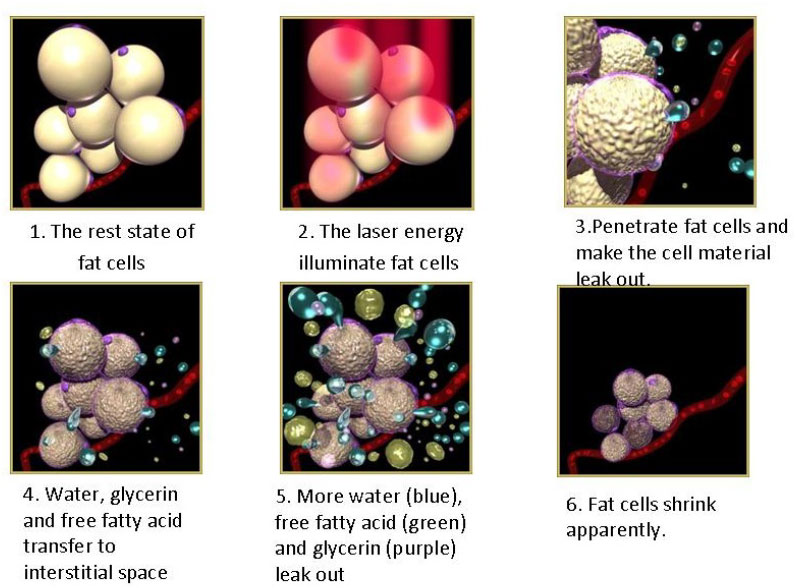 Chart of The Effect Cold Laser Has On Fat Cells